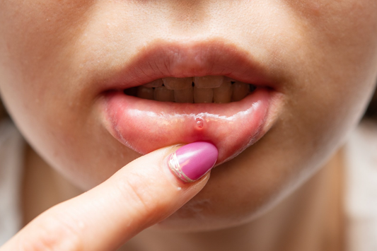 Ultimate Guide on How to Cure Ulcer in Mouth: Solutions from Online Pharmacy